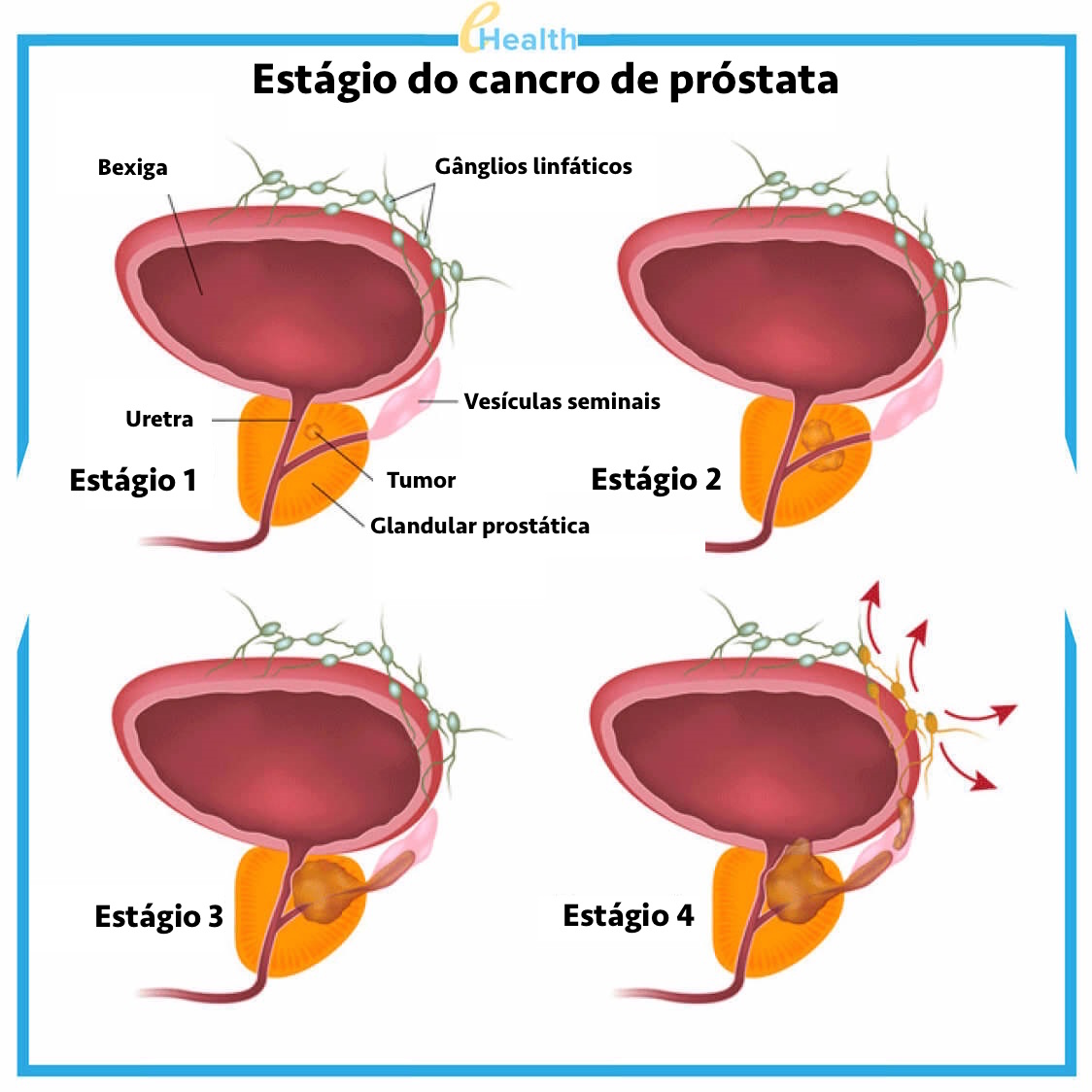 Prostatite Como os farmacêuticos nos enganam vendendo produtos caros contra a ...